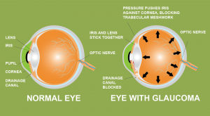 Can Marijuana Help Treat Glaucoma?