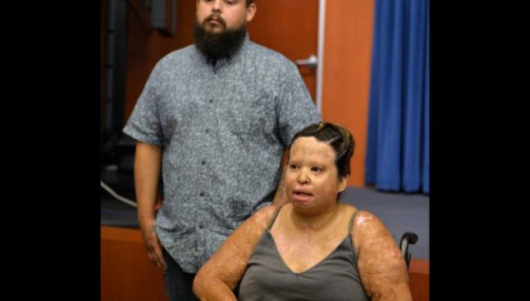 Severely burned couple warn of dangers of making butane honey oil from weed