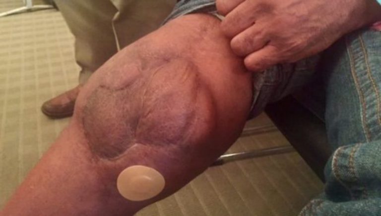 CBD patch turns former NFL star linebacker into cannabidiol disciple