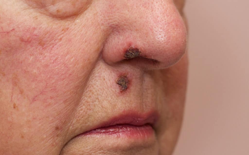 Can Smoking Weed Cause Impetigo?