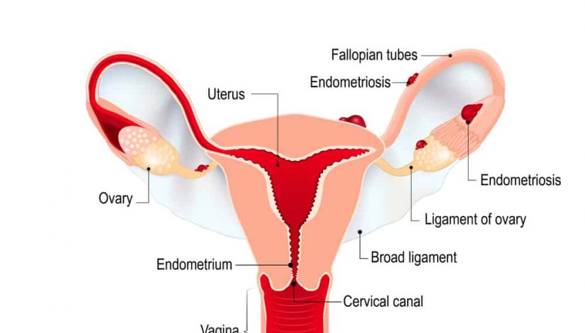 how-to-treat-endometriosis-with-cannabis_1