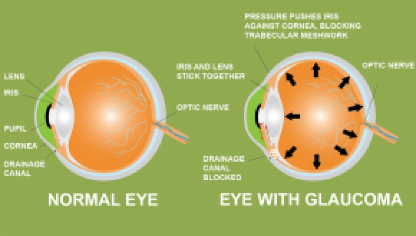 can-marijuana-help-treat-glaucoma_1